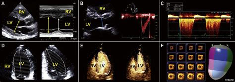 preserved lv systolic function|Lv systolic function assessment.